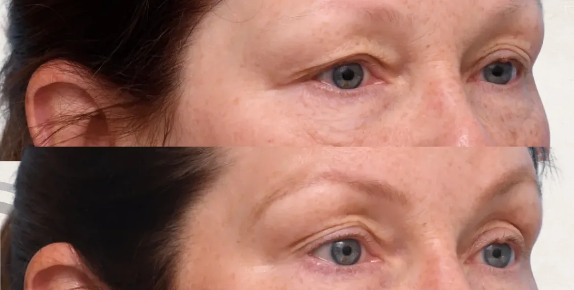 Botox Antifaz